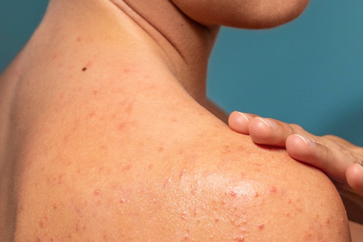 Exactly what do Clogged Pores Look Like?